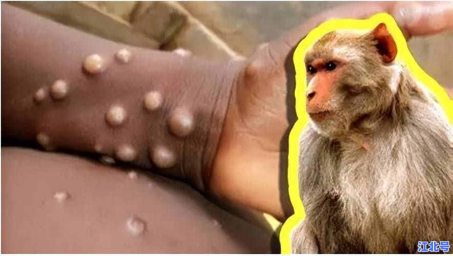 长沙确认一例猴痘病毒境外输入病例：最新流调进展与岳麓区封控区名单更新