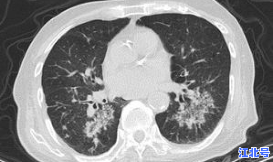 青岛几例新型肺炎？肺炎青岛一例是哪个区