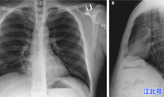 英国新冠肺炎现状(肺炎是怎么引起的)