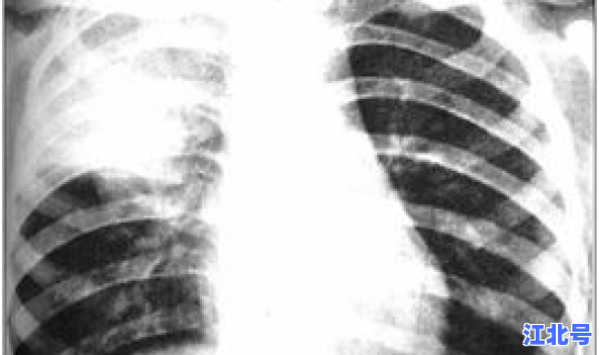 陕西西安出现几例肺炎 西安有肺炎案例吗