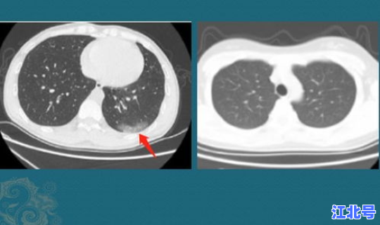 感染新冠病毒会自己痊愈吗 新冠能自己痊愈吗