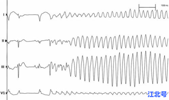 何为传导阻滞(什么是心脏传导阻滞)