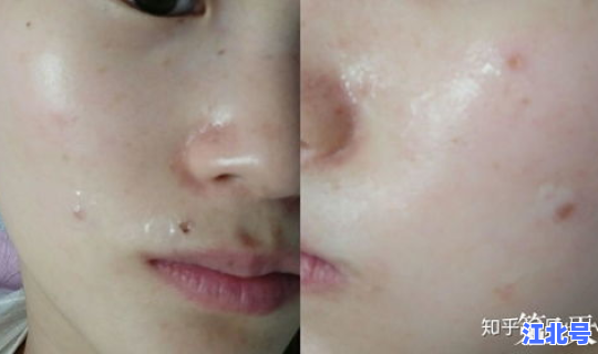 烟台 点痣，烟台祛痣排行最好的医院