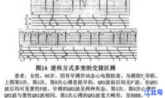隐匿性传导的发生机制 隐匿性是什么意思
