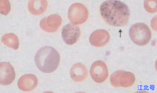 混合性细胞？混合性红细胞要紧吗