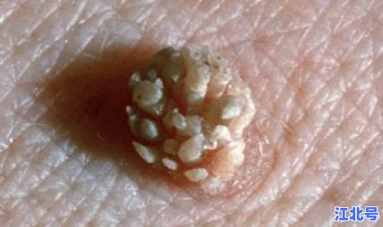 无症状感染者的几率有多大？感染hpv有什么症状