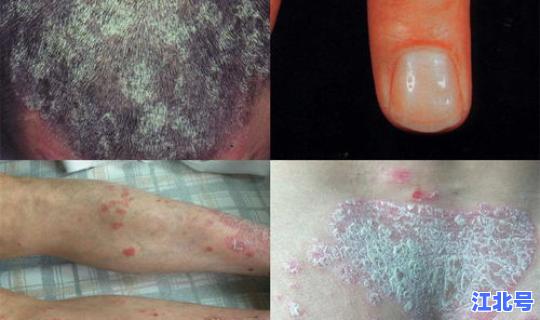 无症状感染者的传染性有多大，梅毒14传染性大吗