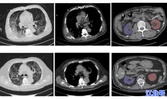 英国新冠病毒感染情况，什么原因引起病毒感染
