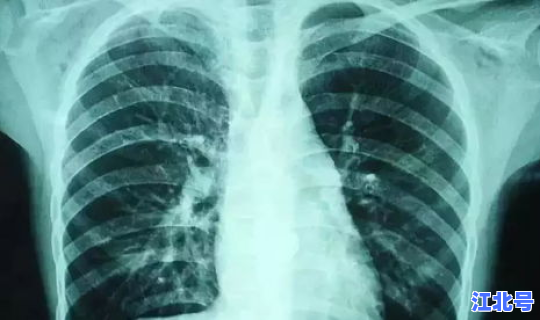云南新增三例肺炎？云南肺部感染哪个医院好