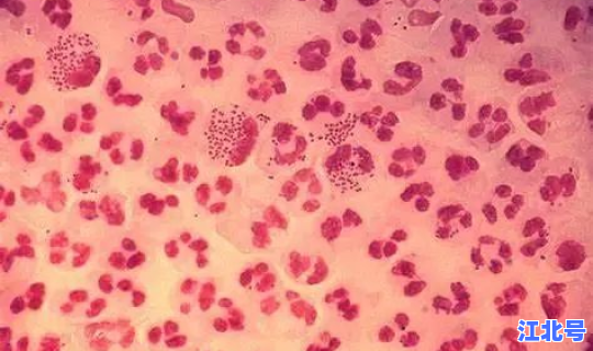 淋病奈瑟菌核酸 阳性(淋病奈瑟菌核酸检测)