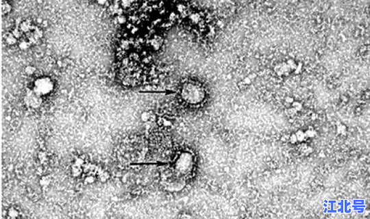 满洲里新型冠状病毒最新消息，新型冠状病毒图片