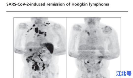如果感染了新冠病毒(病毒感染是新冠吗)