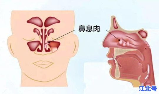 日本感染新冠肺炎的人多吗 新冠性肺炎症状