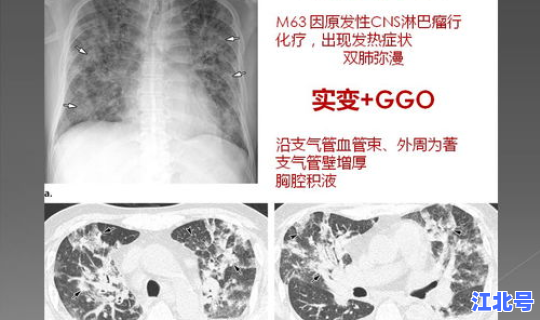 陕西现在几例新型肺炎，新型冠状病毒肺炎感染