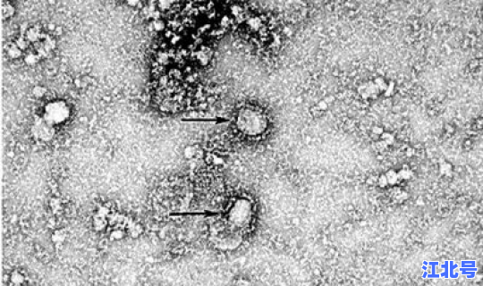 第1例新型冠状病毒，新冠病毒第一个感染者