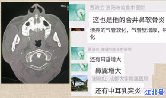 复发性软骨炎全国有多少例，复发性多软骨炎20年