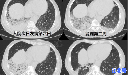莆田新型冠状肺炎几例(目前莆田有没有新型肺炎) 莆田新型冠状肺炎几例(目前莆田有没有新型肺炎)