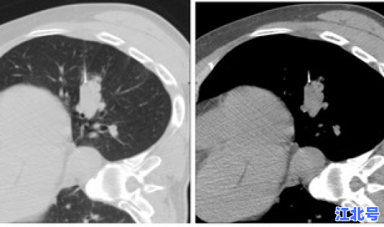 郑州确诊病例名单？郑州人民医院官网