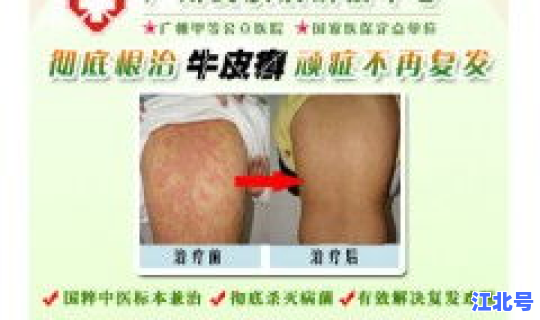 广东汕头最新病情，汕头皮肤病医院