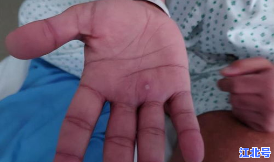 猴痘病毒的临床症状有哪些 猴子b病毒