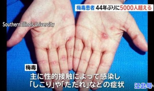 1人传染81人？梅毒会传染给家人吗