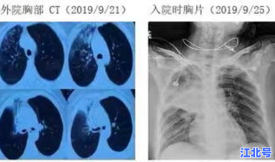 昆明最新新冠肺炎情况通报，新型肺炎的症状有哪些症状