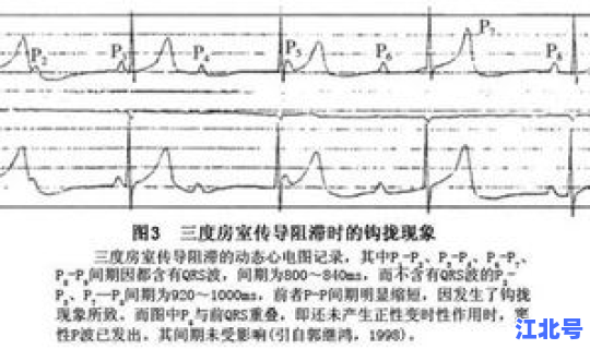 隐匿性传导的发生机制有哪些，房室传导阻滞的发生原理是