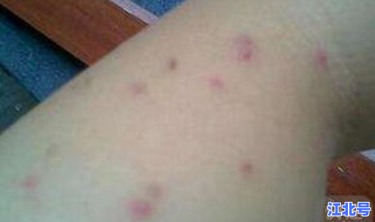 隐匿性病毒？隐藏性梅毒会不会传染