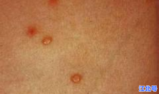 染上传染病多久可以查出来(淋病梅毒多久可以检查出来)