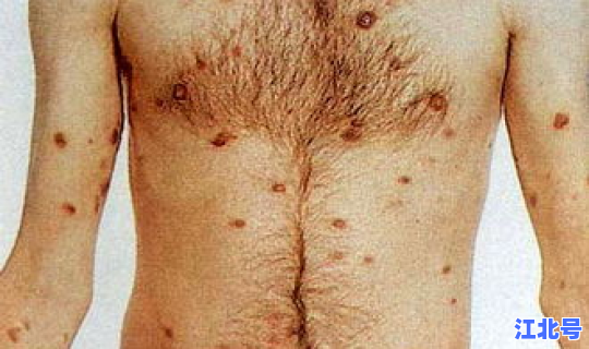 无症状感染者有不传染的吗，急性hiv感染的临床表现