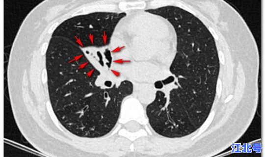 新冠肺炎中发生的感人故事，新冠性肺炎症状