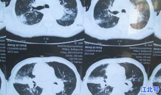 沈阳18例新型肺炎(沈阳发现一例肺炎吗)