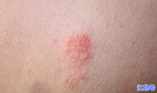 无症状有传染，带状疱疹传染吗