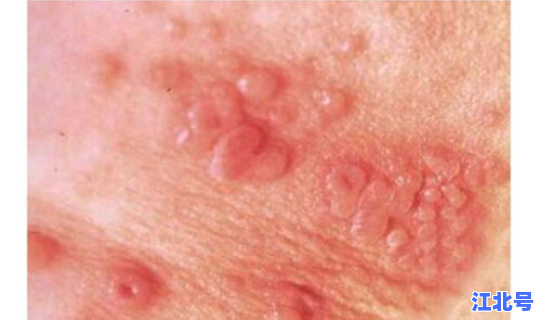 生殖疱疹无症状会传染人吗 得了生殖疱疹还能跟正常人谈恋爱吗