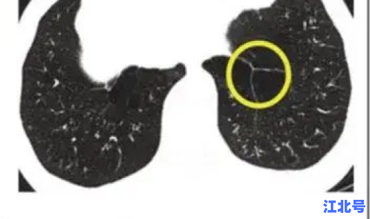 无症状感染者最终？艾滋病病毒感染者是指