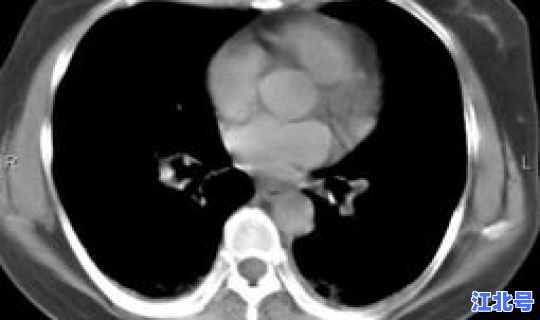 成都市最新肺炎情况 新型肺炎实时状态
