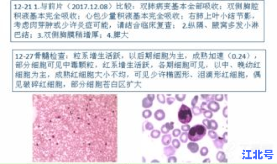 噬血细胞综合症全国有多少例 噬血细胞综合征能治愈吗