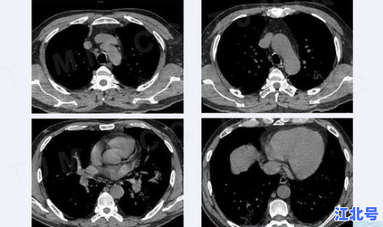 福建泉州感染新型肺炎人数及分布 新型肺炎的症状有哪些症状