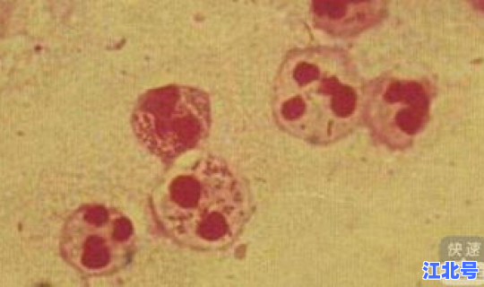 淋病奈瑟菌检测阳性是淋病吗 淋球菌阳性是什么病