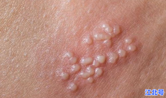 感染新冠病毒多久具有传染性？感染艾滋病毒多久会有症状