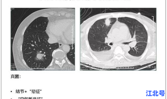 河南有没有新型冠状病毒肺炎(河南现在哪里有新冠疫情)