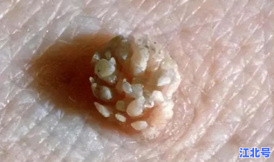 无症状感染者有哪几种情形，感染hpv有什么症状