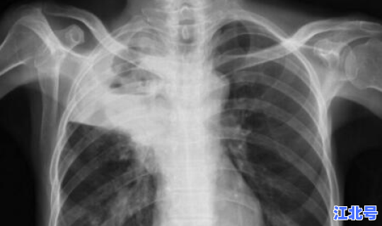 新增相关肺炎？吸入性肺炎