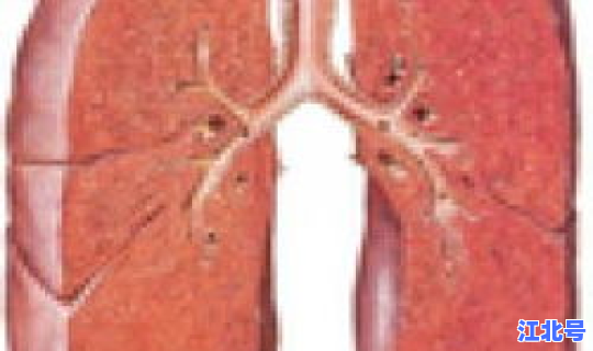 新冠肺炎无感染国家(病毒性肺炎会传染吗)