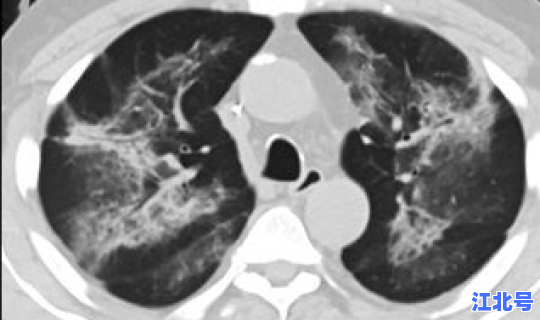 感染新冠有救吗 新冠肺部感染能自愈吗