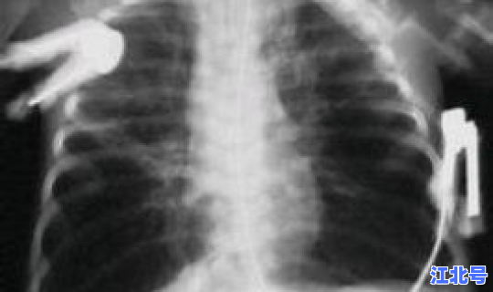 国外新冠肺炎变异(支气管肺炎)