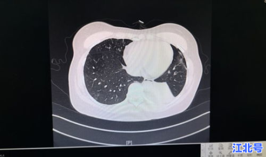 感染新冠肺炎有救吗？新冠肺部感染能自愈吗