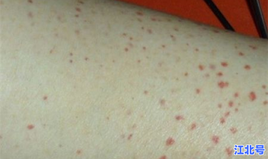 无症状感染者有传染吗 艾滋病潜伏期会传染吗