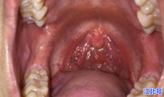 拉肚子嗓子肿是新冠吗，喉咙痛拉肚子