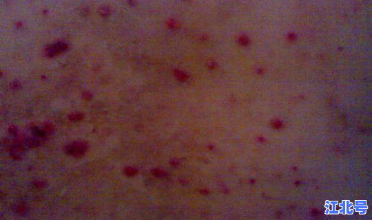 河南有病毒感染吗(皮肤病毒感染)